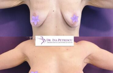 masto-implant-gallery-003-490x508x30x0x430x508x1636448939