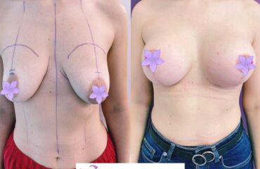 masto-implant-gallery-004-928x702x34x0x860x702x1636448939