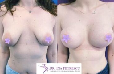 masto-implant-gallery-005-443x273x6x0x430x273x1636448939