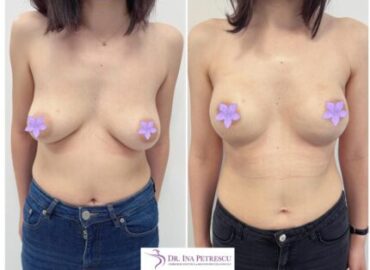 reconstr-implant-jan-2023-2-434x352x0x0x430x352x1675267131