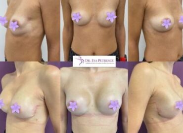 reconstructie-sani-implant-gallery-002-473x417x17x0x430x417x1636448939