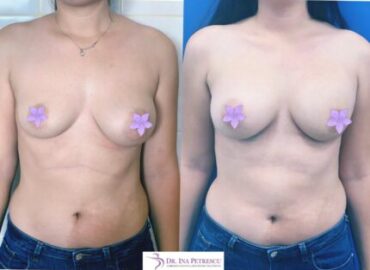 reconstructie-sani-implant-gallery-003-430x430x0x6x430x417x1636448939