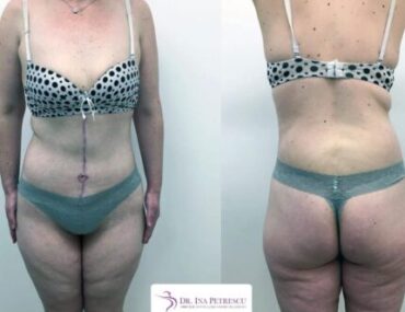 total-body-gallery-007-520x365x45x0x430x365x1636448939