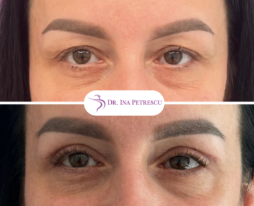 Blefaroplastie