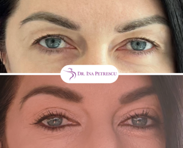 Blefaroplastie (2)