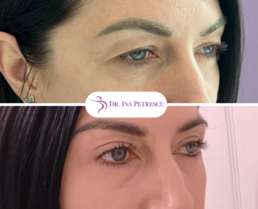 Blefaroplastie (3)