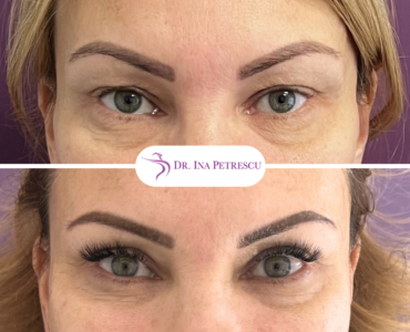 Blefaroplastie