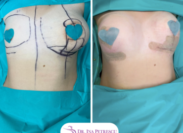 Reconstructie cu implant
