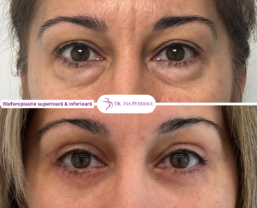 Blefaroplastie