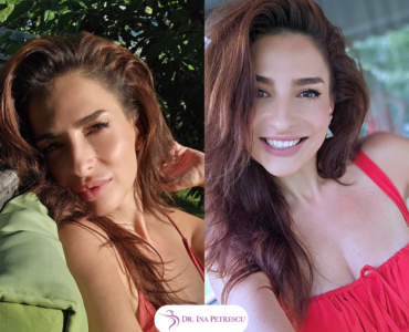 AH + Botox