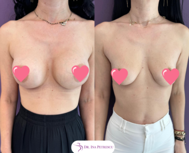 Implant mamar