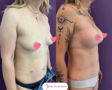 Mommy Makeover (2)