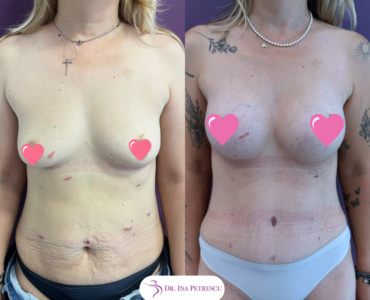 Mommy Makeover