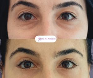 Why choose blepharoplasty
