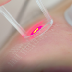 Tratament facial cu laser co2