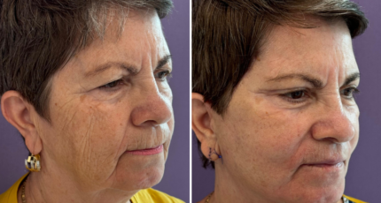 Lifting Facial mamar (2)