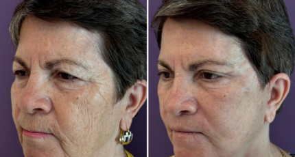 Lifting Facial mamar (3)