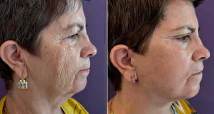 Lifting Facial mamar (4)