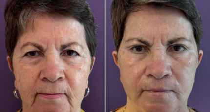 Lifting Facial mamar