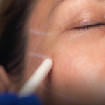 Lifting facial nechirurgical - NAMICA By APTOS