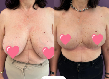 Reconstructie mamara