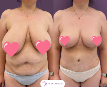 Mommy Makeover