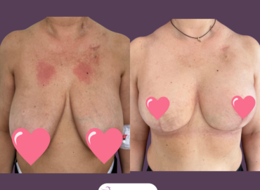 Reconstructie mamara cu implant