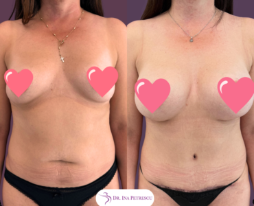 Mommy Makeover