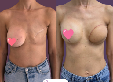 Reconstructie cu implant