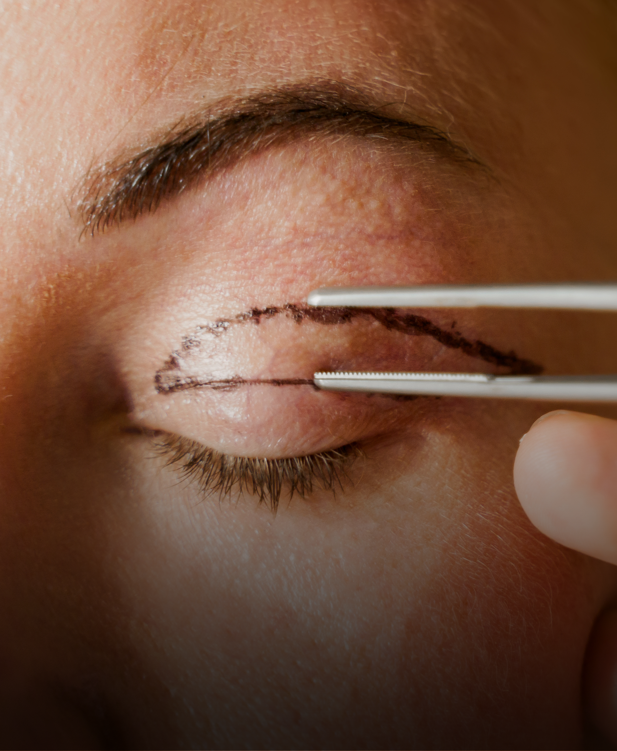 What to expect during recovery after blepharoplasty?
