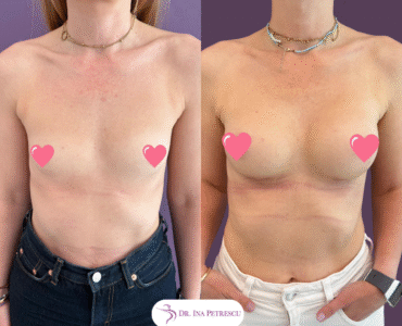 Total Body Lift