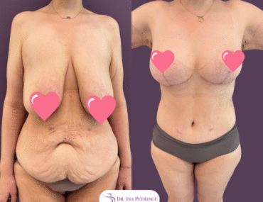 Total Body Lift