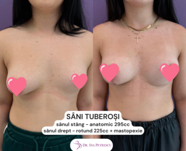Implant mamar - Sani tuberosi