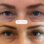 Blefaroplastie_Ina-Petrescu